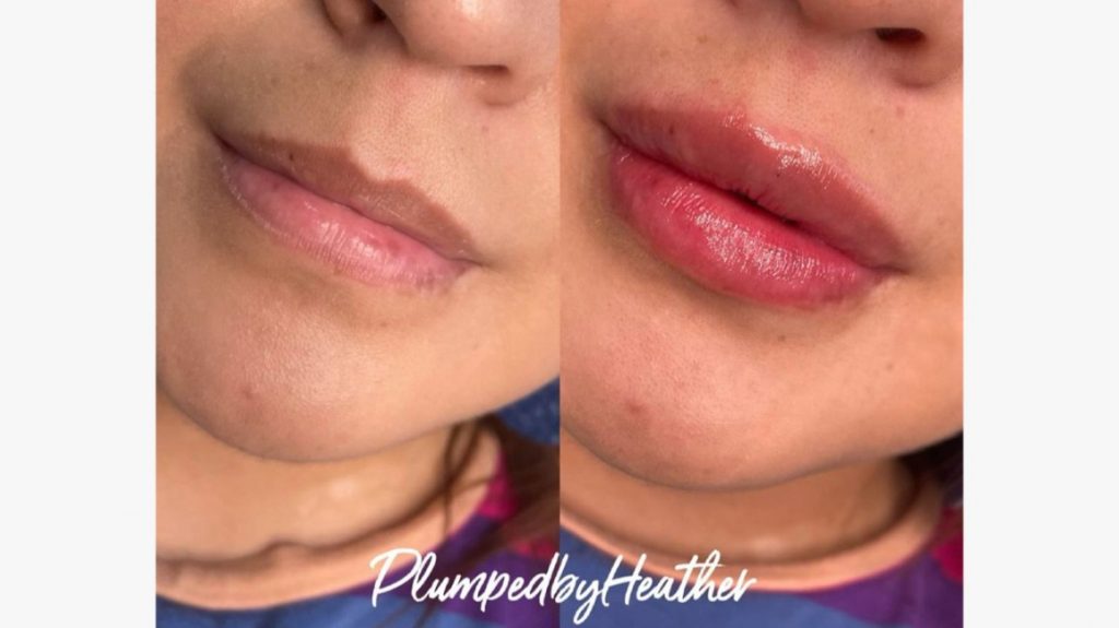 Hyaluronic lip injections before and after case screenshot from Healthline