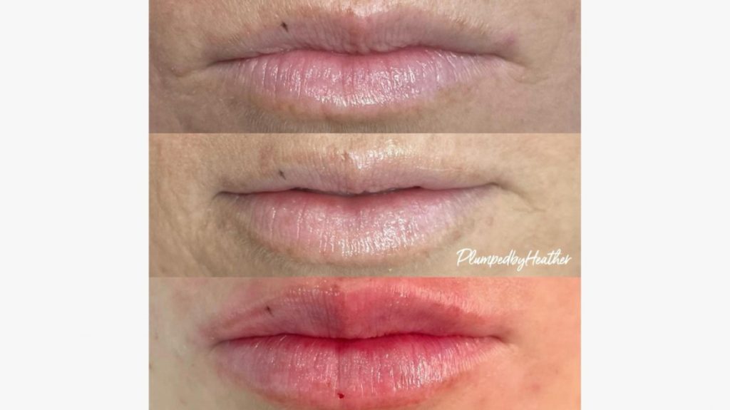 Hyaluronic lip injections before and after case screenshot from Healthline