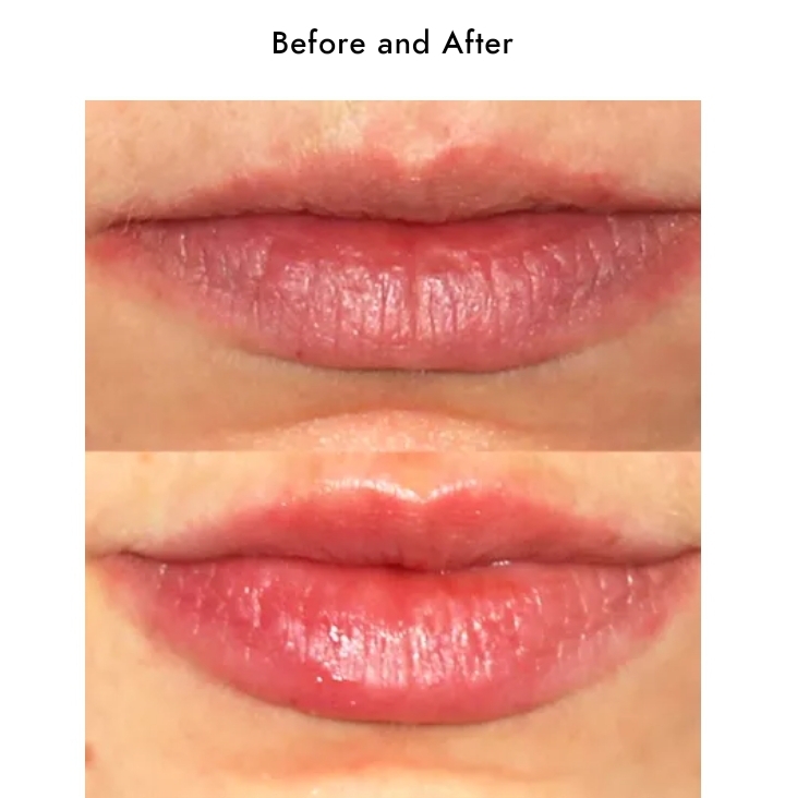 Hyaluronic lip injections before and after case screenshot from Facileskin