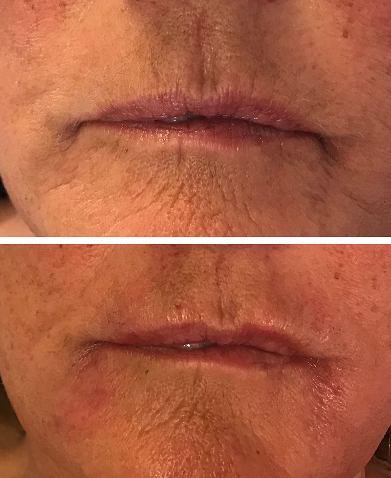 Hyaluronic lip injections before and after case screenshot from Refineme