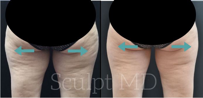 SculptMD CoolSculpting before and after