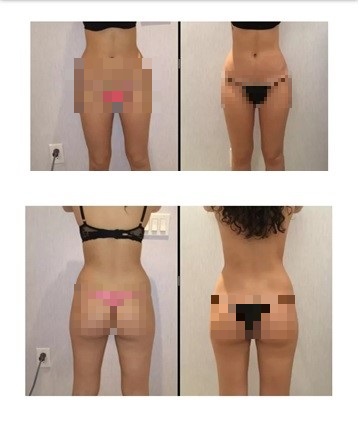 Skinney Medspa CoolSculpting before and after