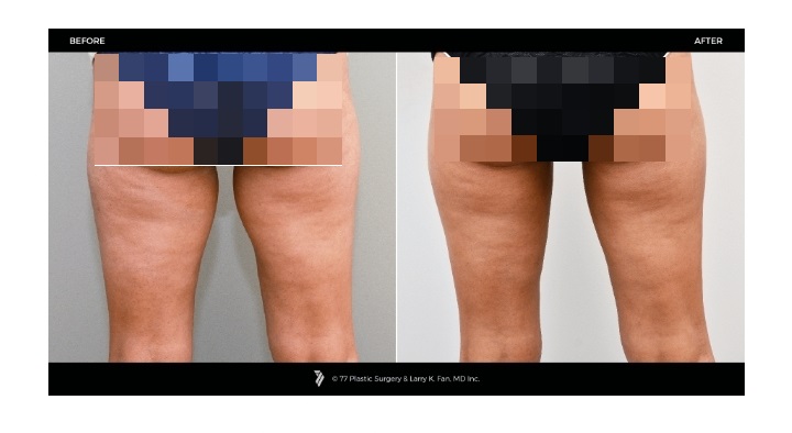 77 Plastic Surgery CoolSculpting before and after