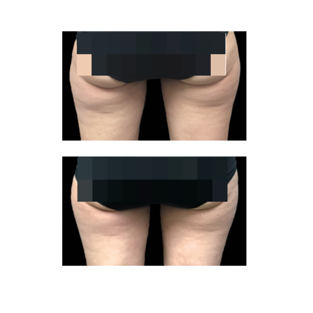 CoolSculpting procedure before and after