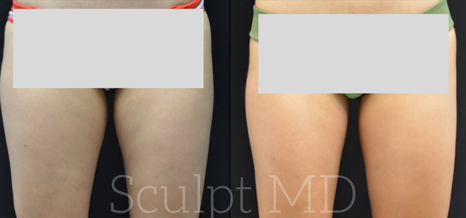 Sculpt MD CoolSculpting before and after
