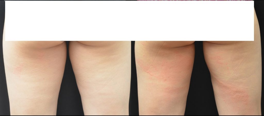 SculptMD CoolSculpting before and after
