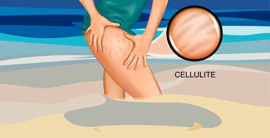 Why Do Women Get Cellulite?